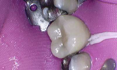 Dental-Crown-After-Image