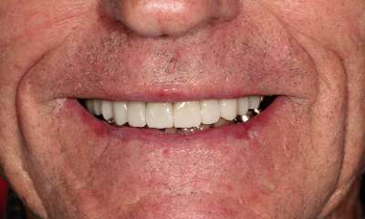 Smile-Makeover-After-Image