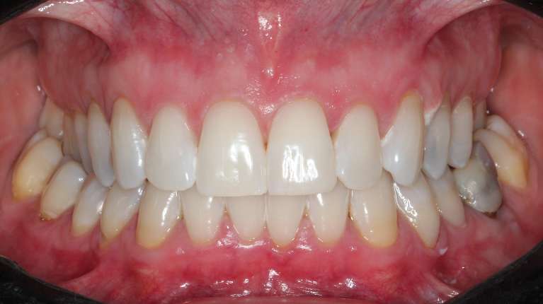 Teeth-whitening-After-Image