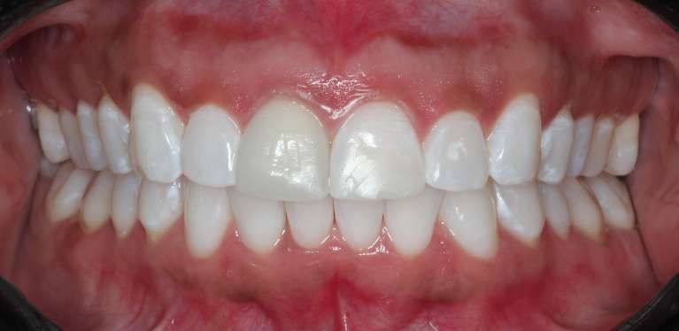Teeth-Whitening-After-Image