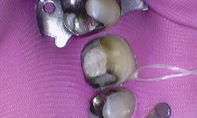 Dental-Crown-Before-Image