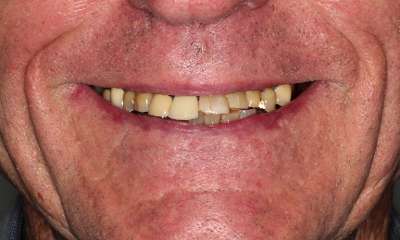 Smile-Makeover-Before-Image