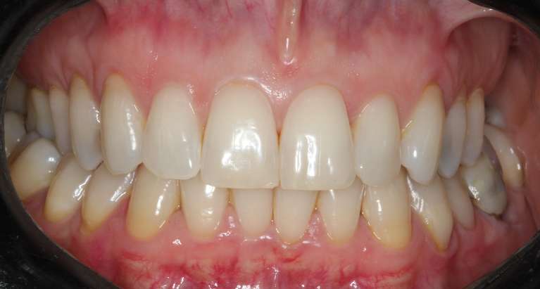 Teeth-whitening-Before-Image