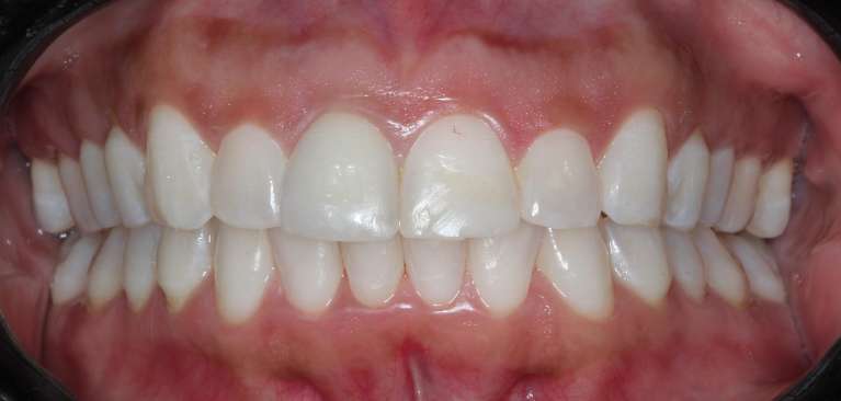 Teeth-Whitening-Before-Image